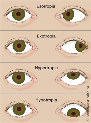 Types-of-strabismus 